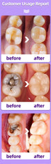 Fast-Acting Cavity & Tooth Decay Solution | Strengthens Enamel & Fights Caries