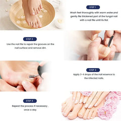 Fungal Nail Treatment Serum – Anti-Fungal Repair Gel for Foot & Nail Care | Onychomycosis & Paronychia Solution