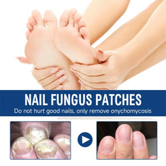 Fungal Nail Treatment Serum – Anti-Fungal Repair Gel for Foot & Nail Care | Onychomycosis & Paronychia Solution