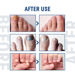 Fungal Nail Treatment Serum – Anti-Fungal Repair Gel for Foot & Nail Care | Onychomycosis & Paronychia Solution
