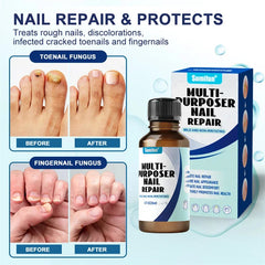 Fungal Nail Treatment Serum – Anti-Fungal Repair Gel for Foot & Nail Care | Onychomycosis & Paronychia Solution