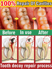 Advanced Tooth Decay Solution | Fights Cavities & Strengthens Enamel for a Healthy Smile