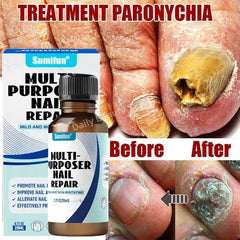 Fungal Nail Treatment Serum – Anti-Fungal Repair Gel for Foot & Nail Care | Onychomycosis & Paronychia Solution