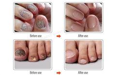 Fungal Nail Treatment Serum – Anti-Fungal Repair Gel for Foot & Nail Care | Onychomycosis & Paronychia Solution