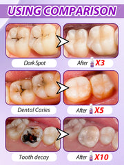 Fast-Acting Cavity & Tooth Decay Solution | Strengthens Enamel & Fights Caries