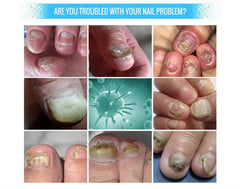 Fungal Nail Treatment Serum – Anti-Fungal Repair Gel for Foot & Nail Care | Onychomycosis & Paronychia Solution