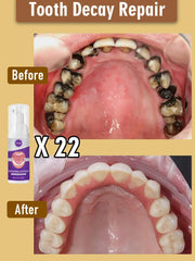 Advanced Tooth Decay Solution | Fights Cavities & Strengthens Enamel for a Healthy Smile